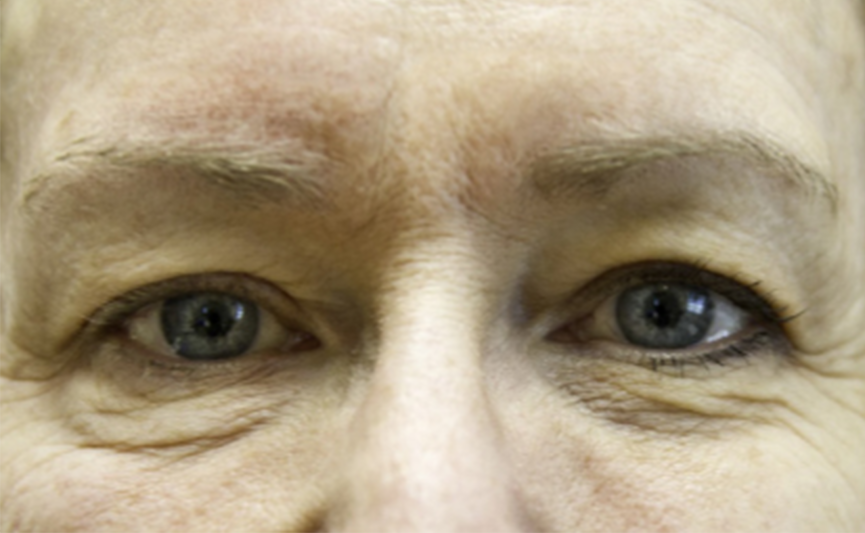 resultado-exilis-01-a