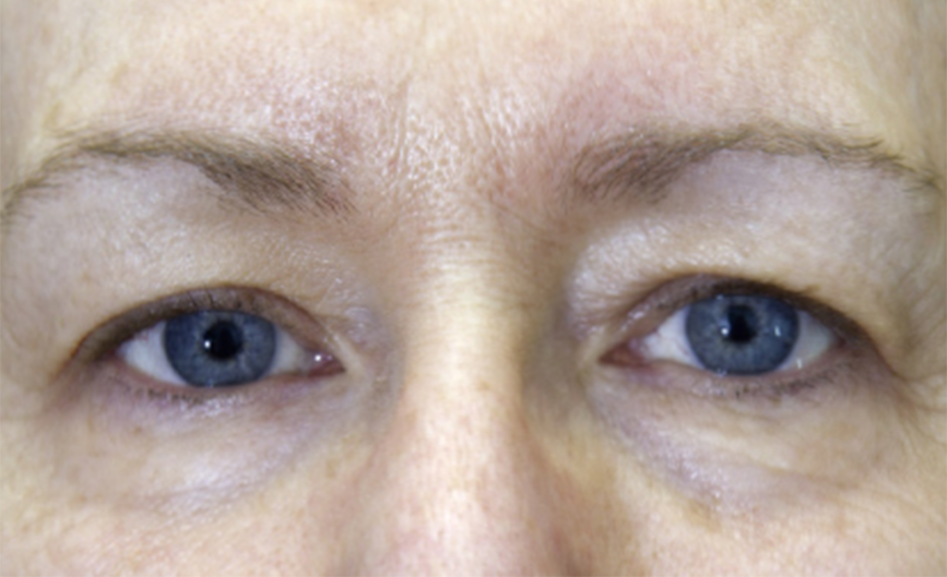 resultado-exilis-01-d