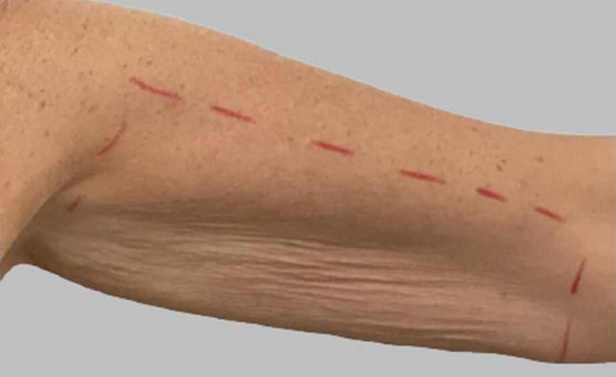 resultado-exilis-04-a