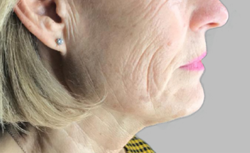 resultado-exilis-05-a