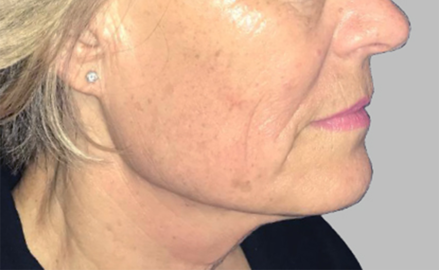 resultado-exilis-05-d