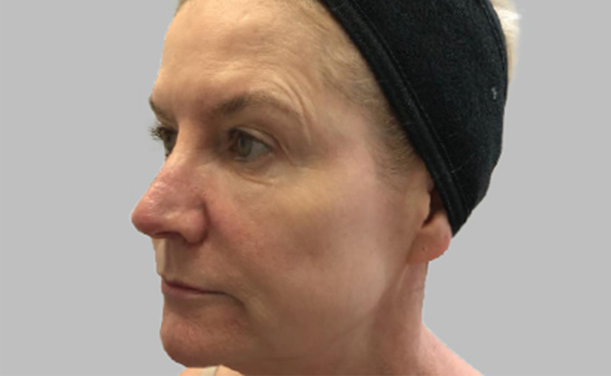 resultado-exilis-06-a