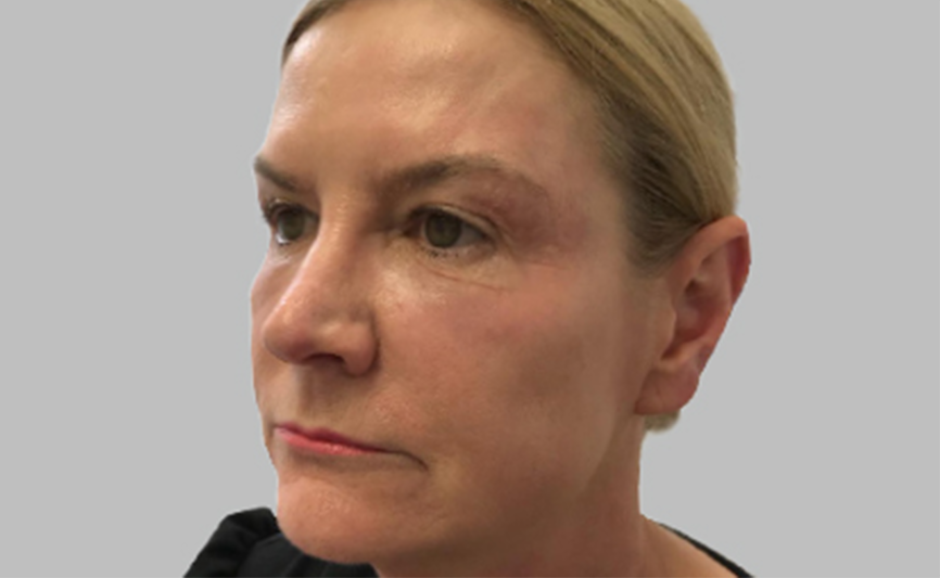 resultado-exilis-06-d