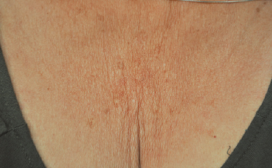 resultado-exilis-08-a