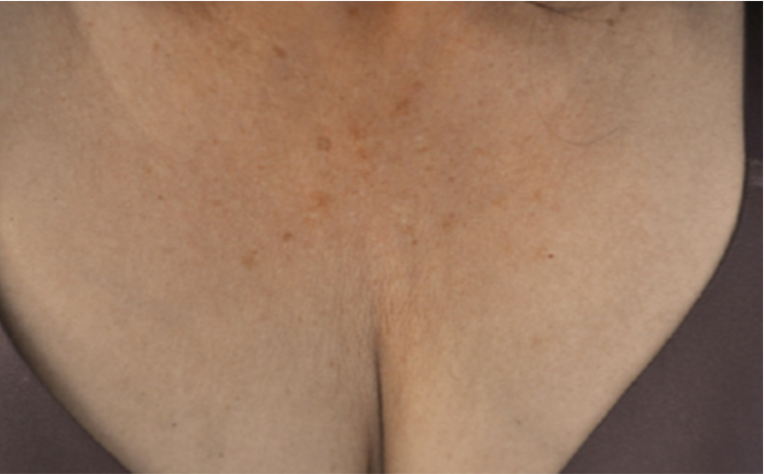 resultado-exilis-08-d