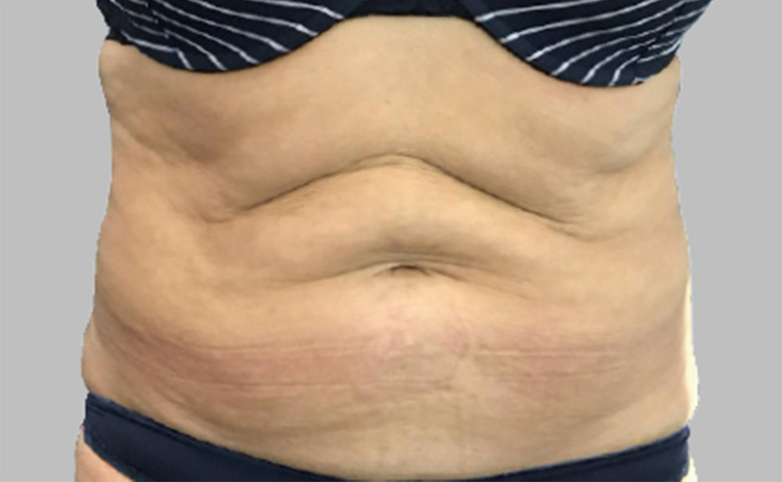 resultado-exilis-10-a