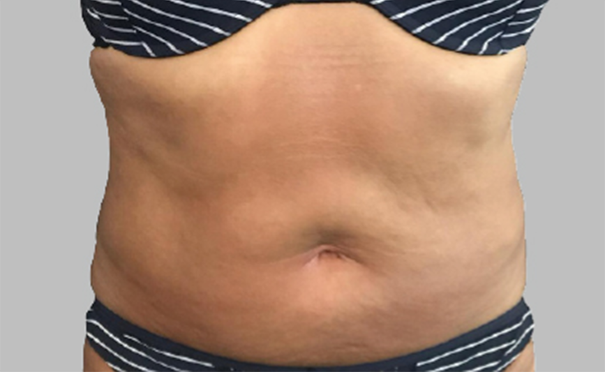 resultado-exilis-10-d